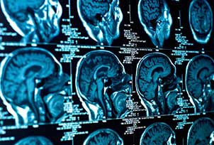 From a Brain Injury Lawyer-Concussions Are Brain Injuries Often Misunderstood
