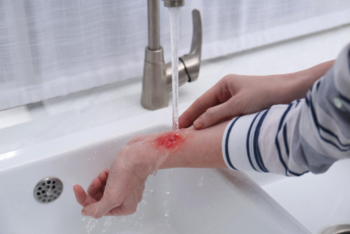 How a Burn Injury Lawyer Can Help You Prove Negligence