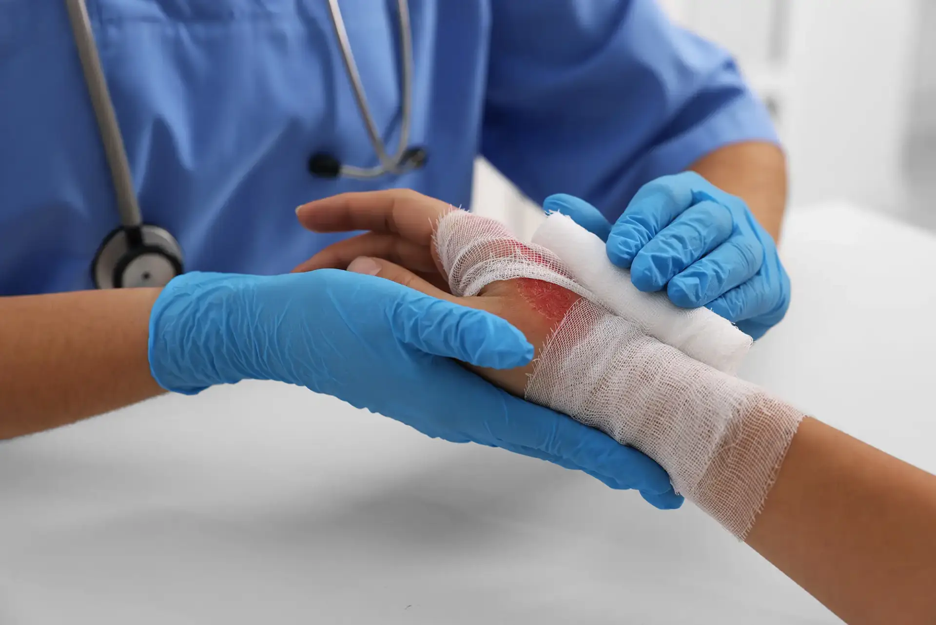Medical professional wrapping a bandage around a patient's severely burned hand